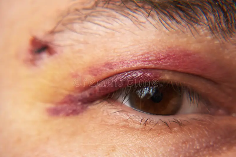 Bruising in Corner of Eye Near Nose