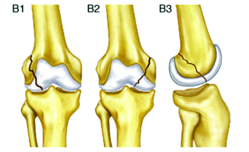medial femoral condyle contusion treatment