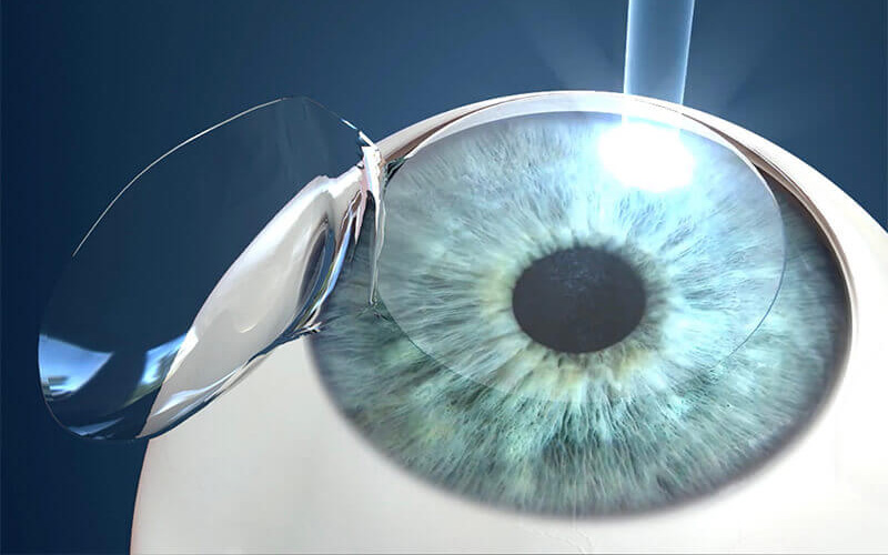 Advantages and Disadvantages of Lasik Laser Eye Surgery