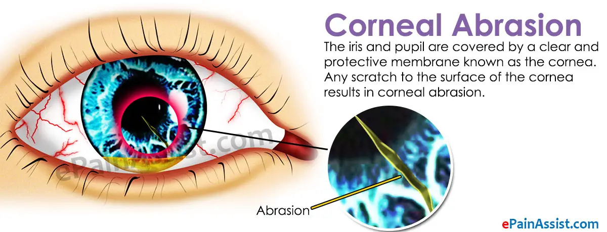 Antibiotic Eye Drops for Corneal Abrasion