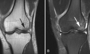Bone Contusion Knee MRI