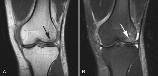 Bone Contusion Knee MRI