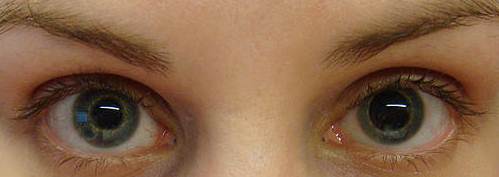 Dilated Pupil After Eye Injury