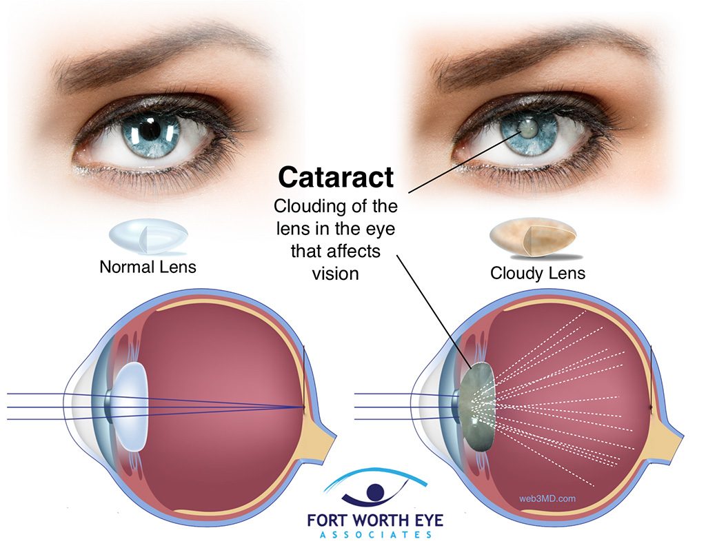 Dilated Pupils after Cataract Surgery