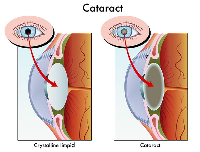 Toric Lenses in Cataract Surgery
