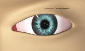 corneal abrasion contact lens antibiotics