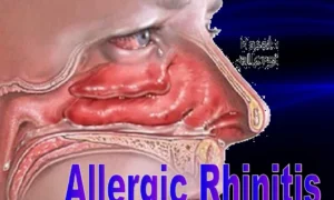 Acute Rhinitis Differential Diagnosis