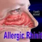 Acute Rhinitis Differential Diagnosis