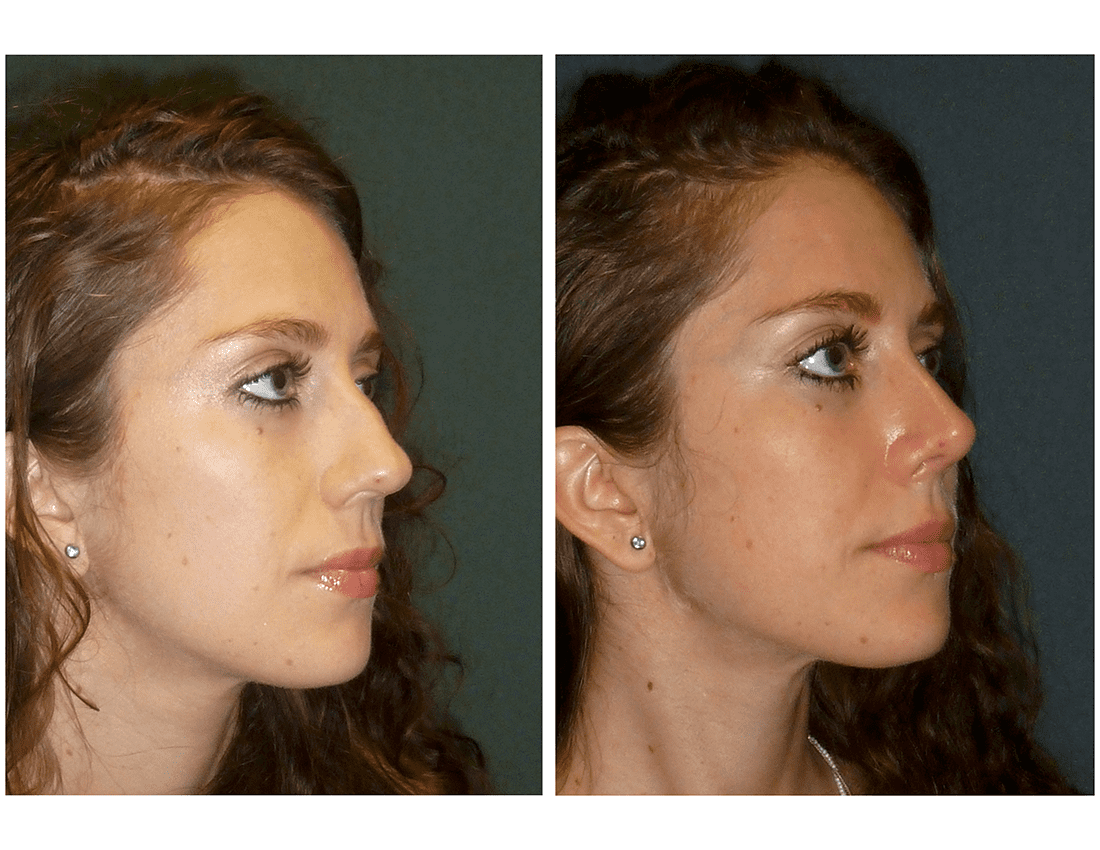Before And After Balloon Sinus Surgery