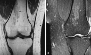 MRI Knee Bone Marrow Edema