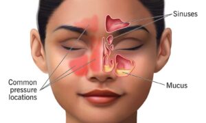 right maxillary sinus polyp icd 10