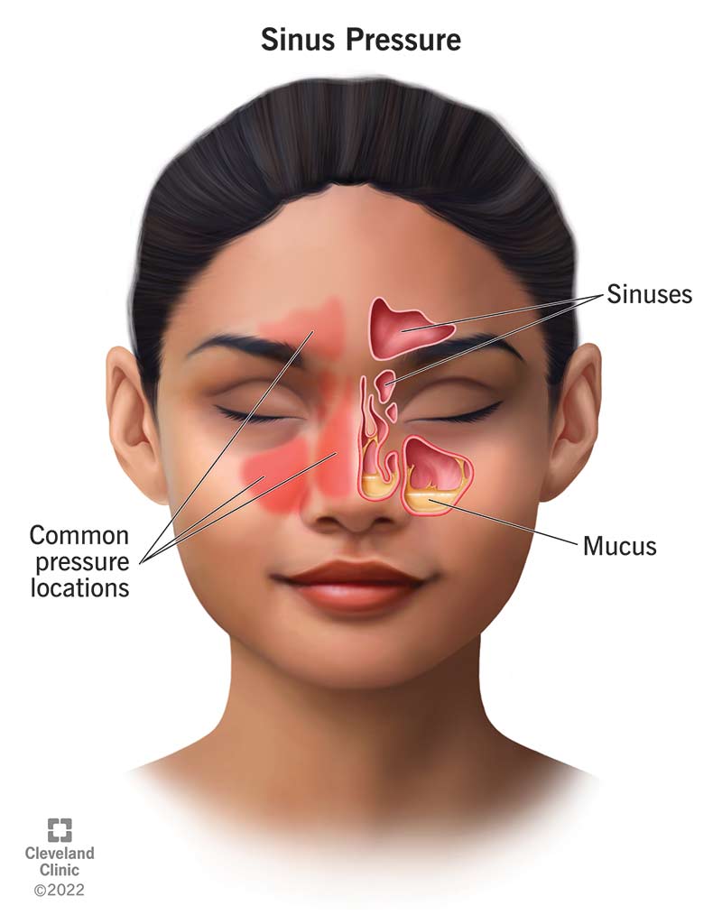 right maxillary sinus polyp icd 10